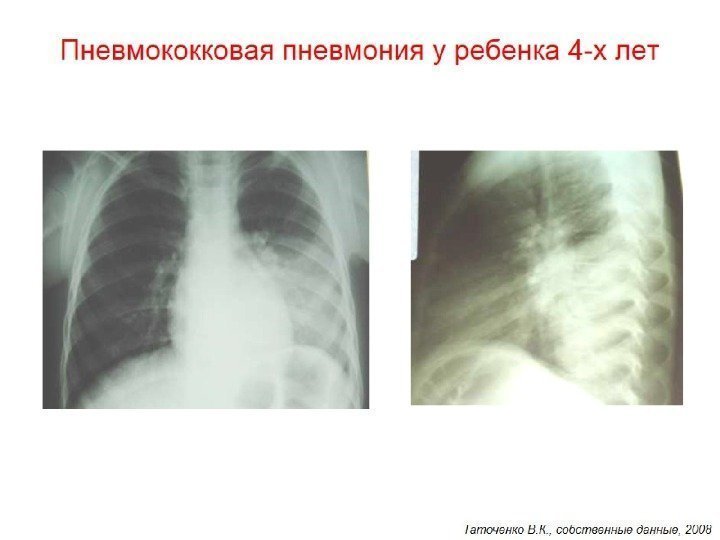 Пневмококковая пневмония у ребенка 4 -х лет 